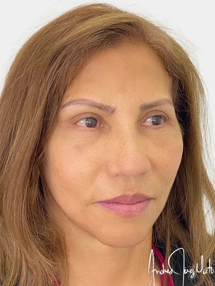 Resultado 1 - Después